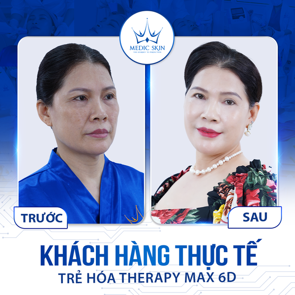 Hình ảnh khách hàng tại Medic Skin trước và sau khi làm dịch vụ trẻ hóa da