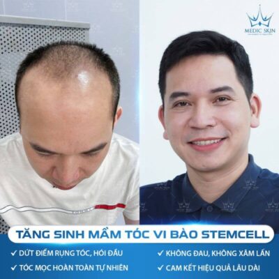 Ưu điểm của cấy tóc vi bào stem cell