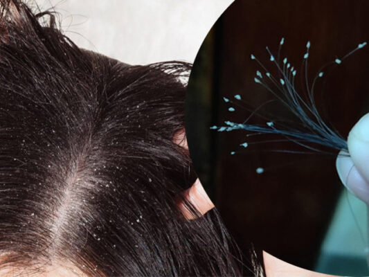 rụng tóc có hạt trắng ở chân tóc