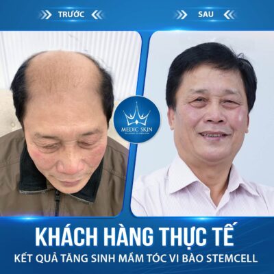 Khách hàng thực tế dịch vụ tăng sinh mầm tóc