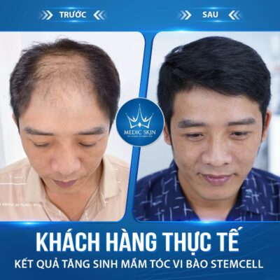 Khách hàng thực tế dịch vụ tăng sinh mầm tóc