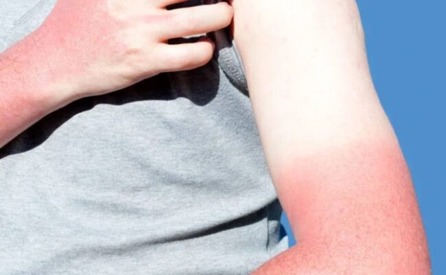 Nhận biết da tay bị cháy nắng