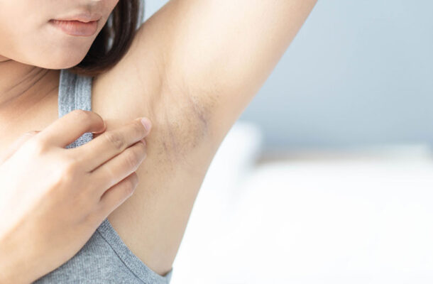 Nách thâm đen nguyên nhân do đâu