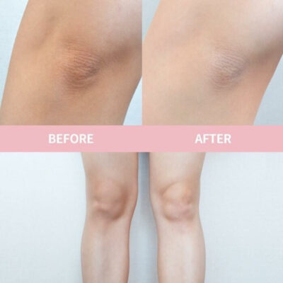 Peel da đầu gối trị thâm